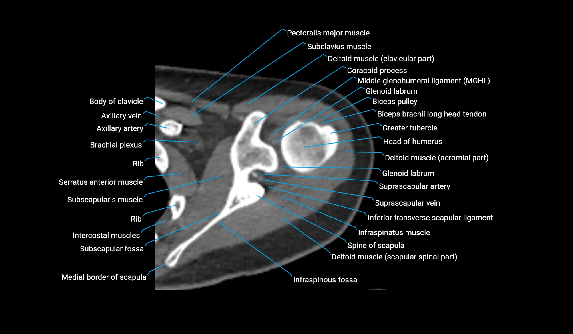 CT upper arm axial  cross sectional anatomy labelled radiology image -00082.webp